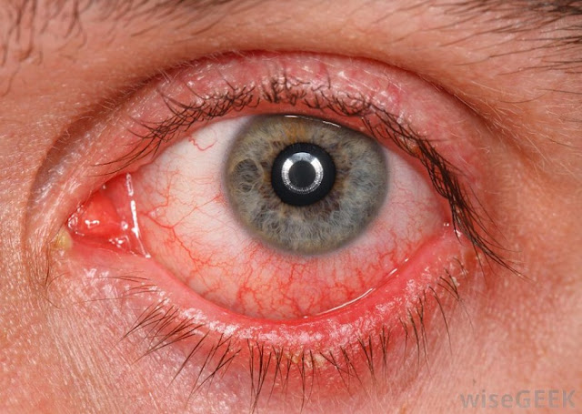 मॉनसून के सीजन में आंखें लाल मतलब कंजंक्टिवाइटिस का खतरा, Ayurvedic treatment of conjunctivitis मॉनसून के सीजन में आंखें लाल मतलब कंजंक्टिवाइटिस का खतरा, Ayurvedic treatment of conjunctivitis