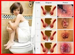 Foto Jual Obat Wasir Murah Berkualitas Paling Ampuh