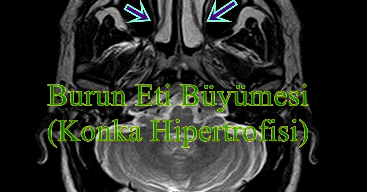 Burun Eti Büyümesi (Konka Hipertrofisi)
