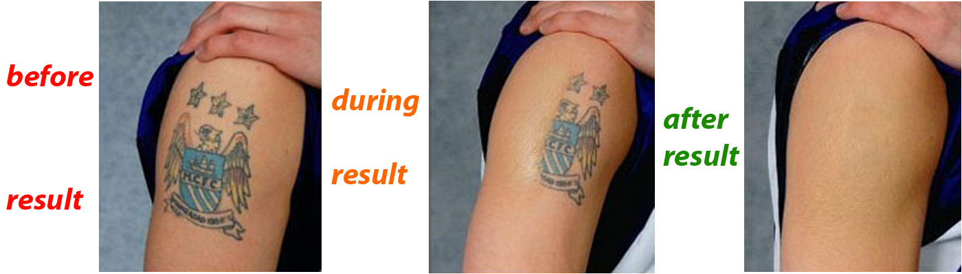 male tattoo removal in delhi best male laser tattoo removal in male tattoo removal in delhi best male laser tattoo removal in