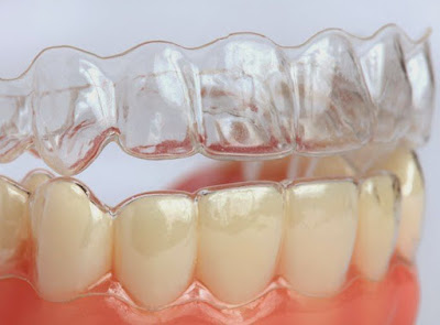 Phương pháp niềng răng không mắc cài Clear Aligner có tốt không?