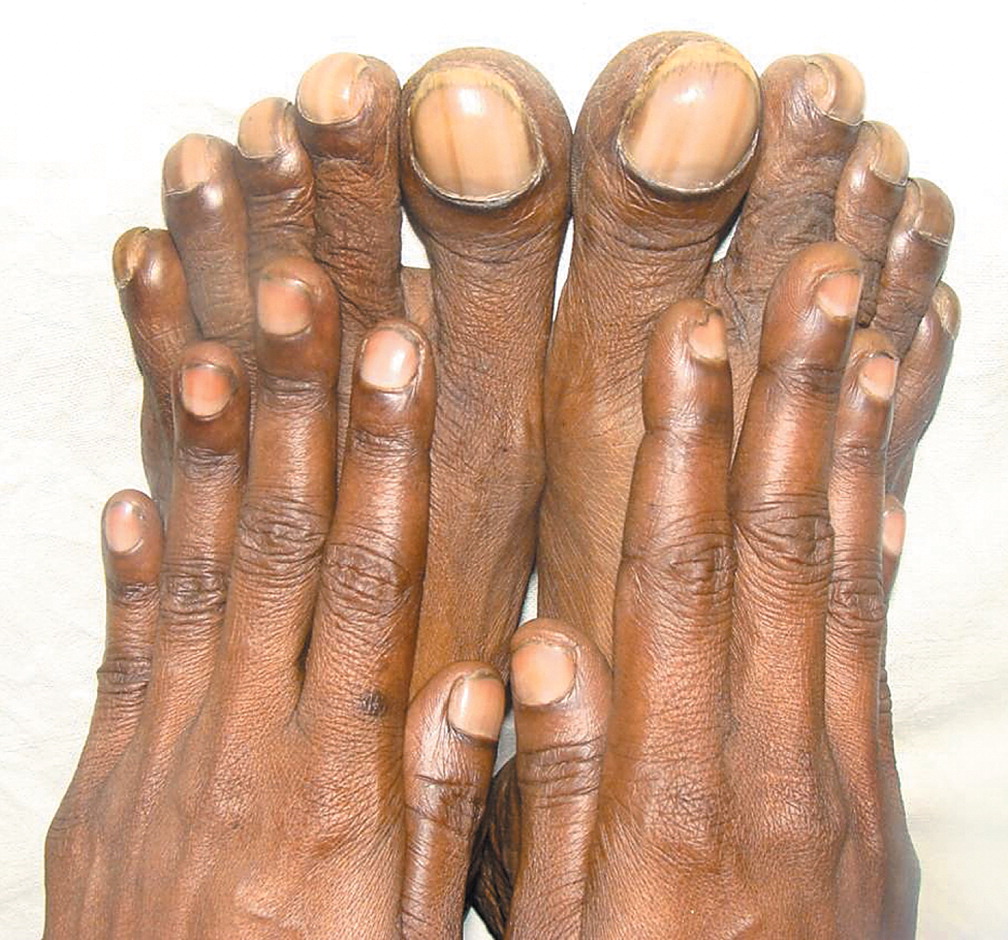 Differential Clubbing And Cyanosis