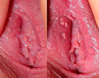 Jual Obat Ampuh Atasi Kutil Yang Tumbuh Di Bibir Vagina