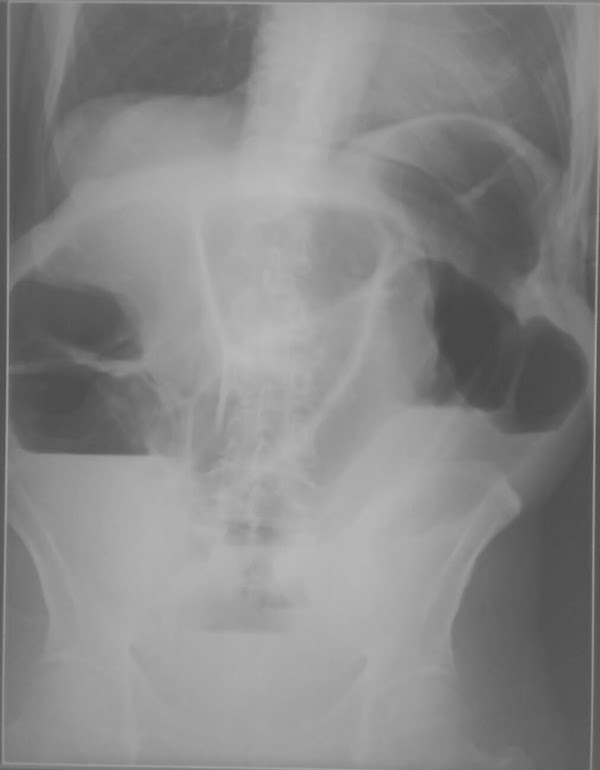 Abdomen agudo quirúrgico: Obstrucción intestinal 