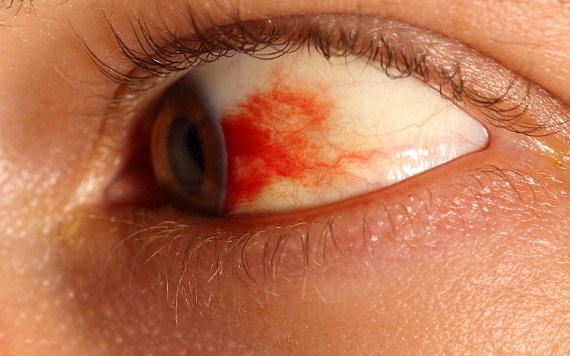 Penyebab Pembuluh Darah Pada Mata Pecah