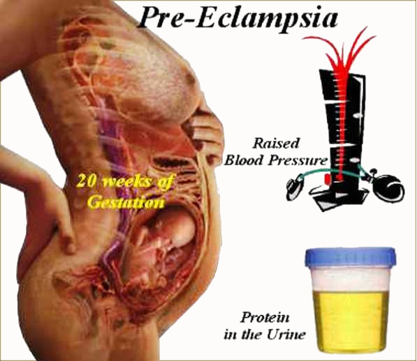 Preeclampsia Causes, Symptoms and Treatment Health And Medical