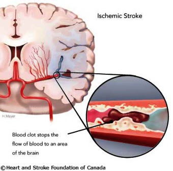 1Stroke Iskemik dan Penyebabnya Stroke Iskemik dan Penyebabnya
