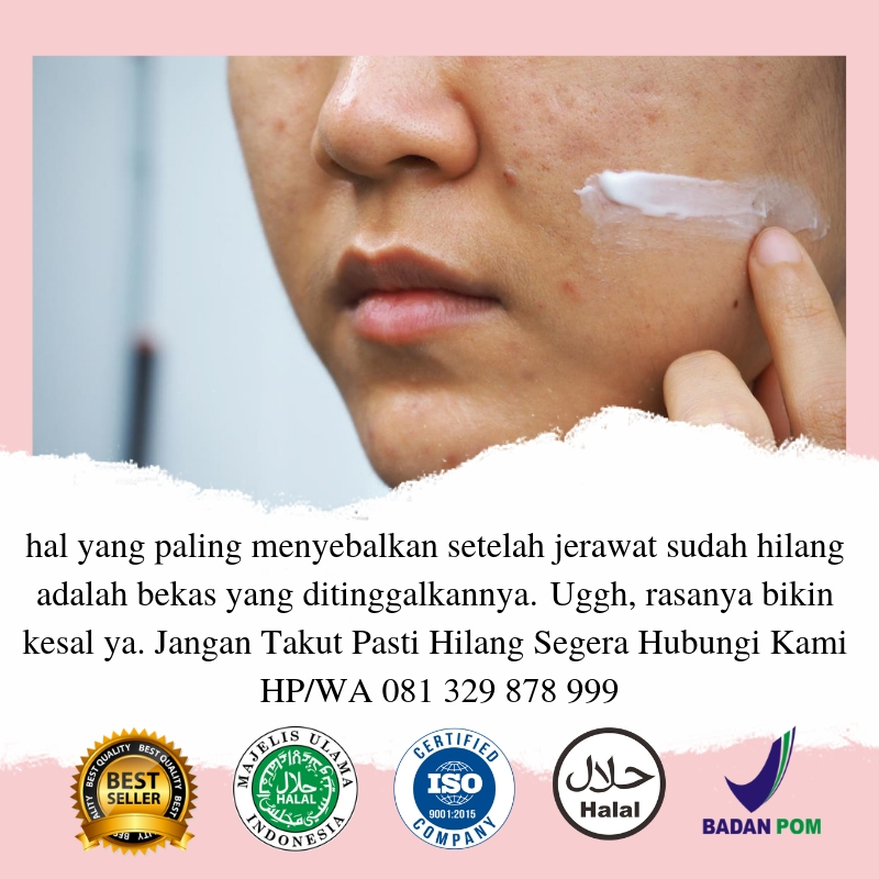 cara menghilangkan bekas jerawat