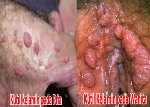 obat kutil kelamin d apotik