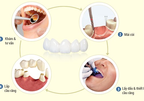 BỌC RĂNG SỨ CÓ HOÀN TẤT TRONG MỘT NGÀY KHÔNG -4