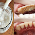Remove Extreme Tartar, Cavities And Plaque Buildup Without Going To The Dentist