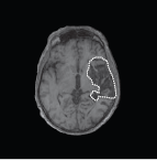 写真：右脳の聴覚野損傷で失音楽症