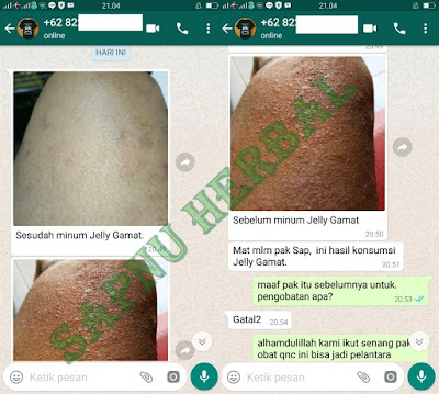 8 Cara Alternatif Mengobati Herpes Atau Dompo 8 Cara Alternatif Mengobati Herpes Atau Dompo