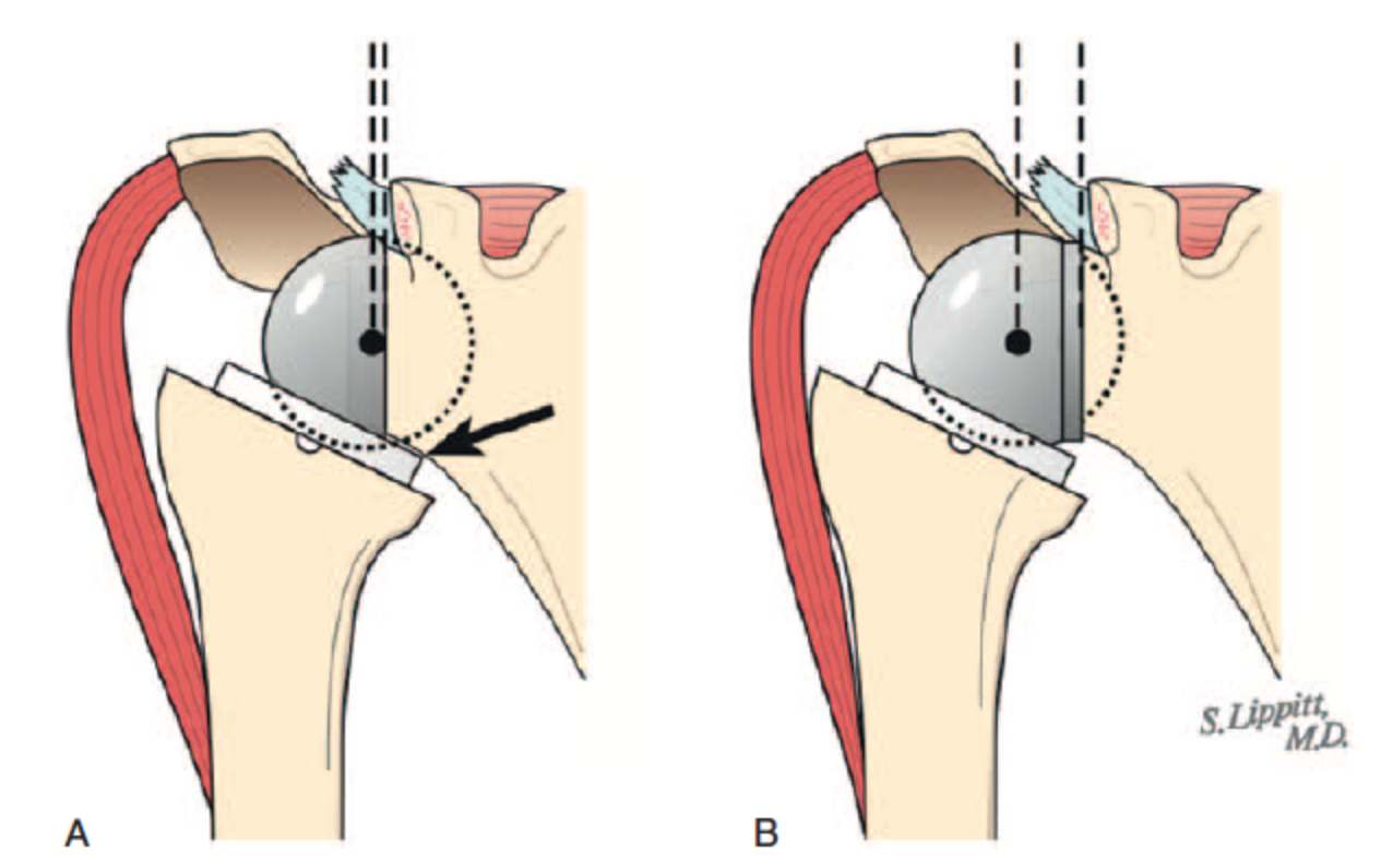 Shoulder and Elbow Surgery Dislocation of reverse shoulder replacement