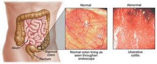 
Νόσος του Crohn
