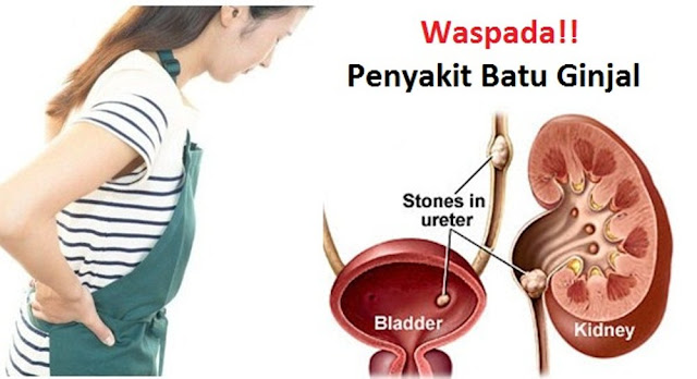 Pengertian, Gejala, dan Penyebab Penyakit Batu Ginjal Beserta Obatnya Pengertian, Gejala, dan Penyebab Penyakit Batu Ginjal Beserta Obatnya