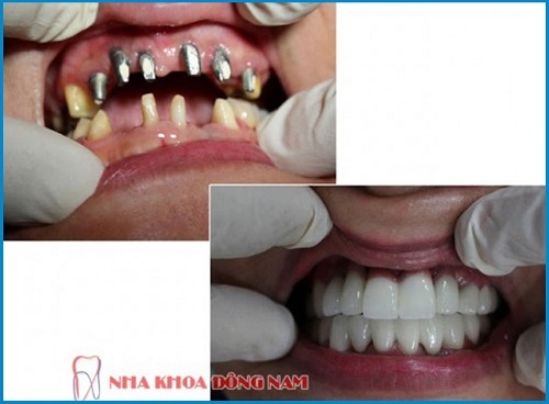CẤY GHÉP XƯƠNG HÀM TRONG TRỒNG RĂNG IMPLANT LÀ GÌ?