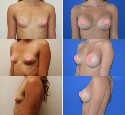 Antes e Depois Mamoplastia de Aumento Antes e Depois Mamoplastia de Aumento