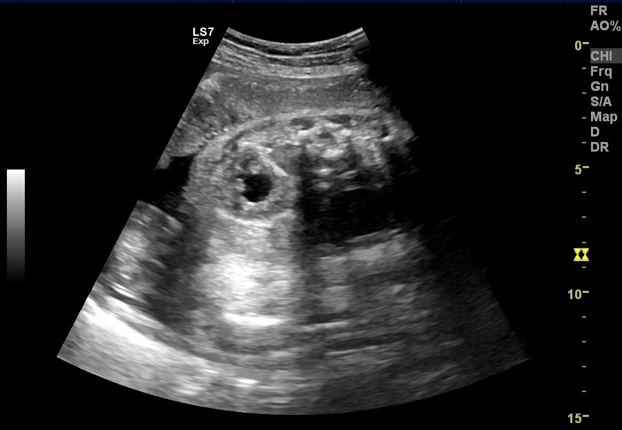 VIETNAMESE MEDIC ULTRASOUND CASE 280 FETUS ONE KIDNEY in