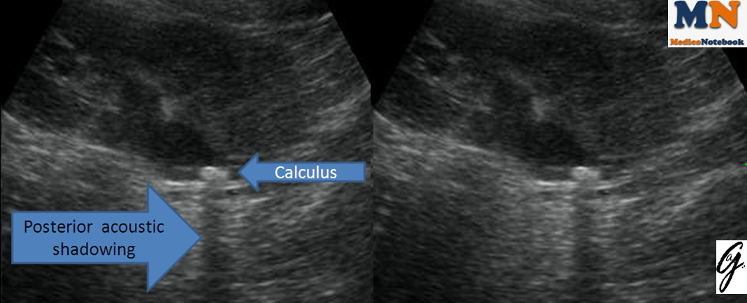 MedicoNotebook: Posterior acoustic shadowing and enhancement