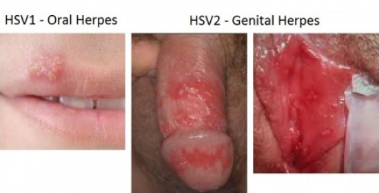 https://2.bp.blogspot.com/-y7asIG77fqE/WOh_nGkQFjI/AAAAAAAAAa4/_bcMaccS0rI35UN-1my3VPx1I1MkELkLACLcB/s1600/genitalis%2Bherpes.jpg