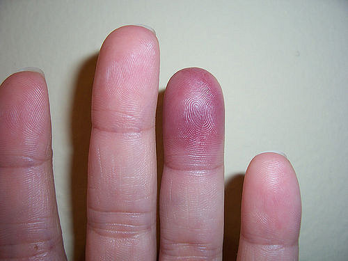 Paroxysmal Finger Hematoma Definition, Symptoms, Causes, Treatment