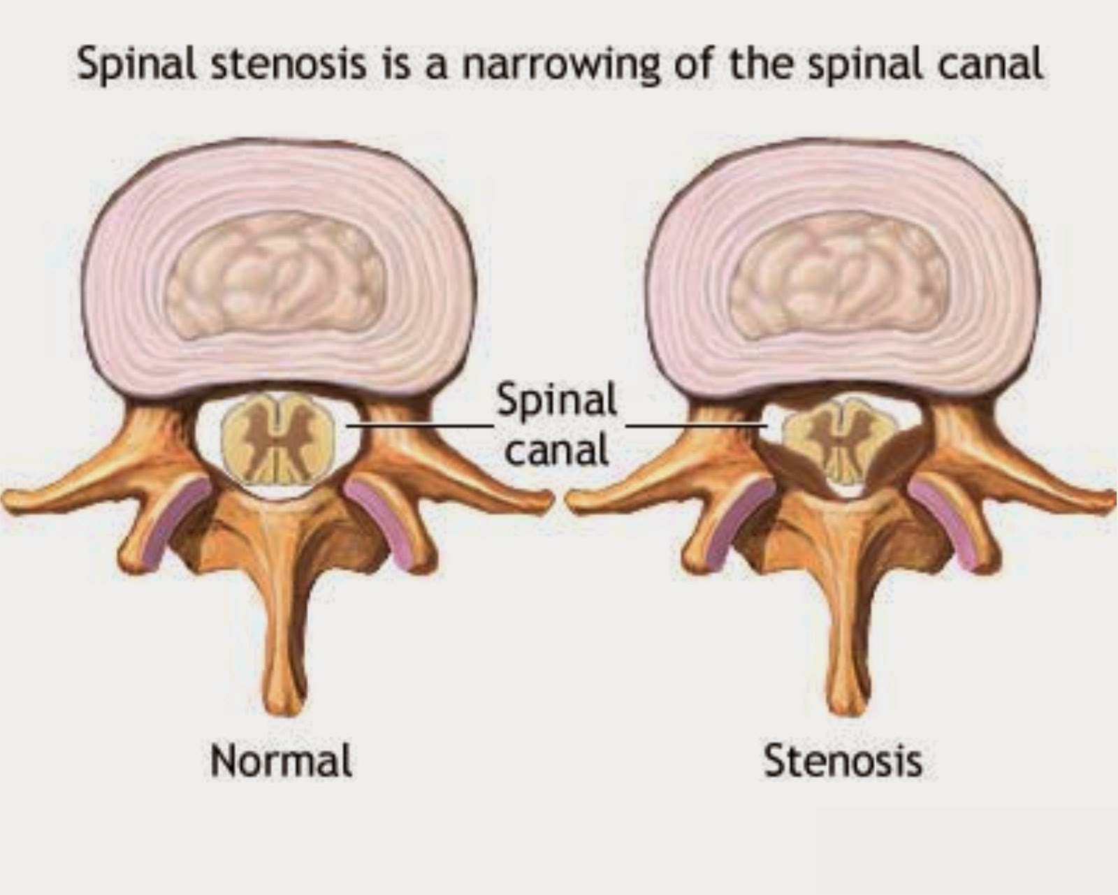 Позвоночный канал сужен что это. Степени сужения позвоночного канала кт. Периневральная киста позвоночника поясничного отдела s1. Межфасеточный фронтальный стеноз позвоночного канала. Позвоночный канал сужен что это.