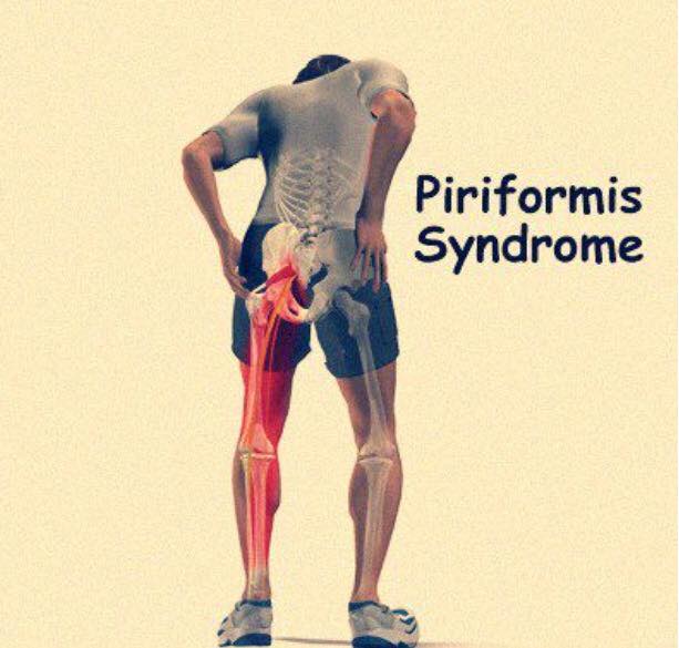 ยืดเหยียดเพื่อลดการเกิด Piriformis syndrome