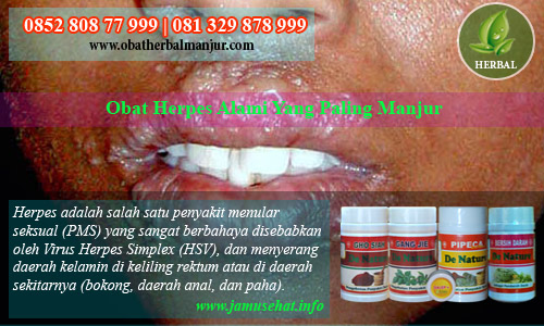 cara menyembuhkan penyakit herpes