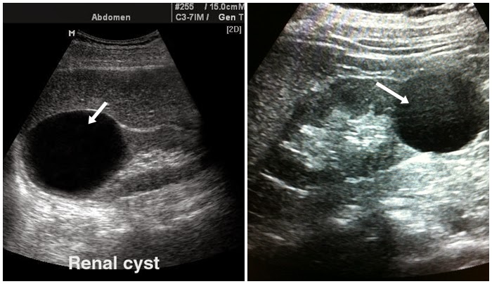 Pemeriksaan USG Ginjal