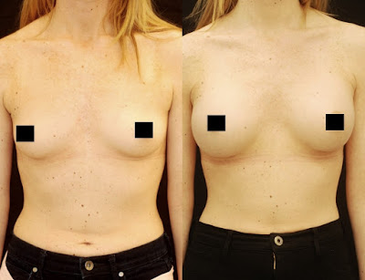 silicone nos seios antes e depois silicone nos seios antes e depois