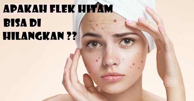 Apakah Flek Hitam Bisa Di Hilangkan Apakah Flek Hitam Bisa Di Hilangkan