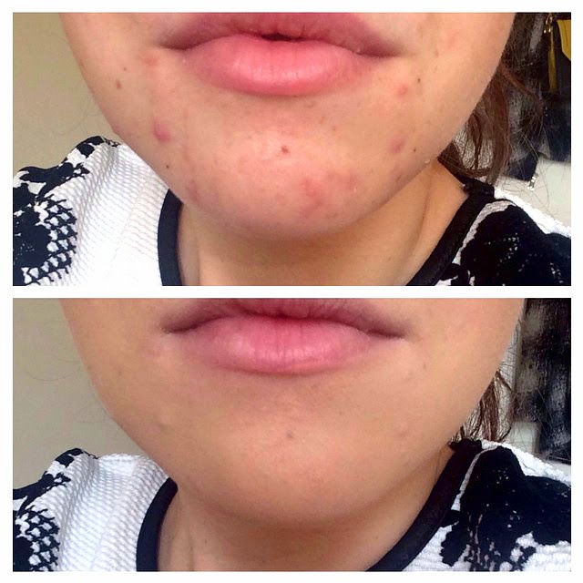 A Blog Upon A Time How to cover up spots