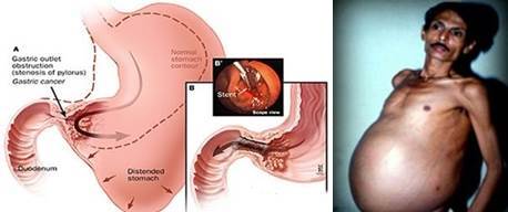 Obat Tumor Ganas Di Perut