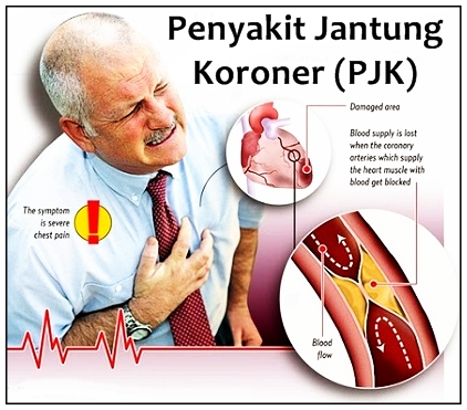 Obat Bahan Alami Untuk Penderita Jantung Koroner ADDY Obat Bahan Alami Untuk Penderita Jantung Koroner ADDY