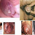 Obat Lubang Penis Merah Sakit Buat Kencing Dan Keluar Nanah
