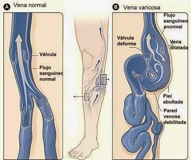 postul cu picior varicos remedii populare în timpul sarcinii de la varicoză