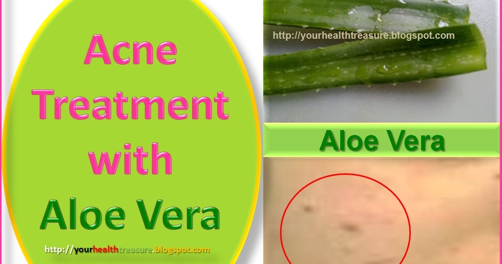 Live Healthy Live Longer How Does Aloe Vera Help In Treating Acne/Pimples?