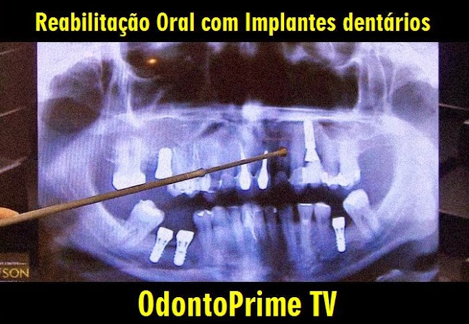 IMPLANTODONTIA: Reabilitação Oral com Implantes dentários