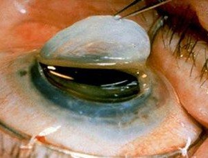 هل تعلمين ان العدسات اللاصقة قد تتسبب بالعمى Do you know that contact lenses may cause blindness