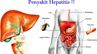 Pengobatan Terapi Lintah untuk Hepatitis