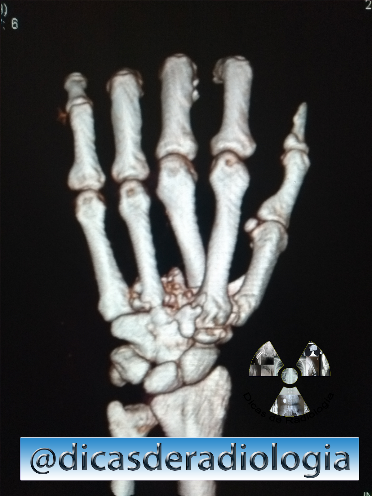 Dicas De Radiologia Tudo Sobre Radiologia Imagens Radiol Gicas Demonstrando Fratura Da Base