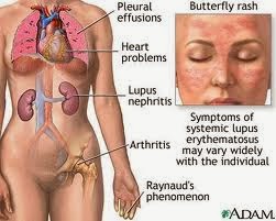 Penyakit Lupus :Penyebab ,Jenis dan Faktor Risiko Penyakit lupus