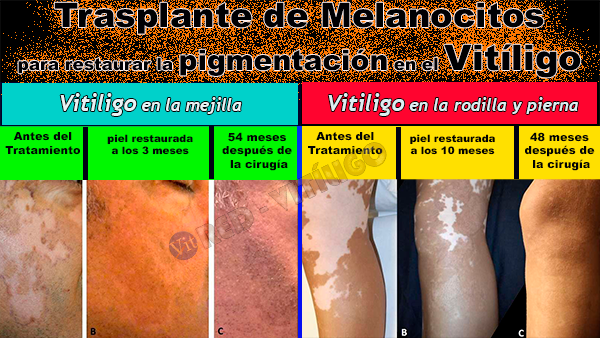 Trasplante de Melanocitos-Tratamiento para el vitiligo