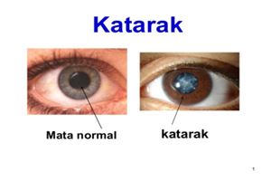 Pengobatan Alternatif Mata Katarak yang Tersedia Pengobatan Alternatif Mata Katarak yang Tersedia