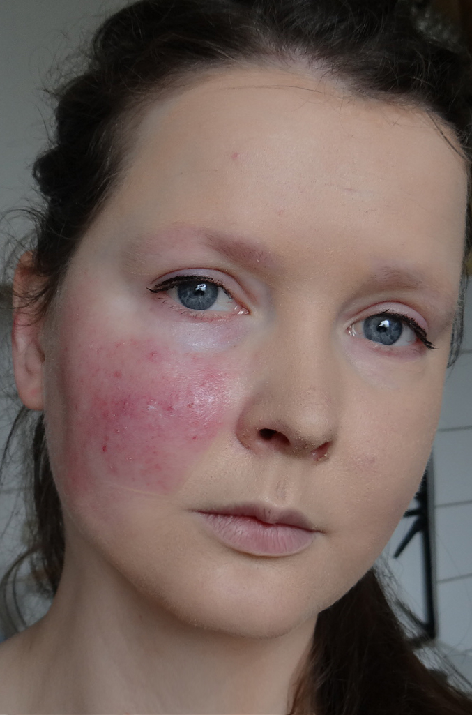 Scarlet Letters, dealing with vascular rosacea, face flushing, burning ...