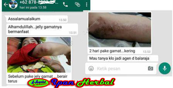 Obat Yang Bagus Untuk Mengeringkan Luka Berair