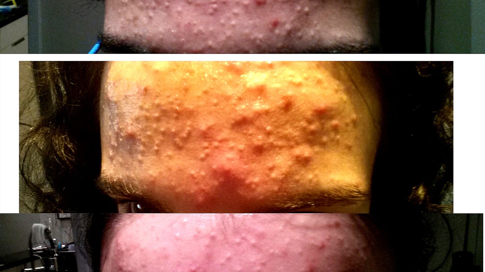 Side Effects Of Epiduo Gel Effect Choices