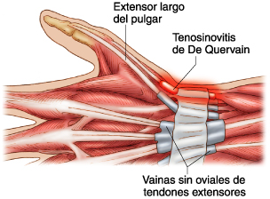 Tendinitis de quervain tratamiento kinesico