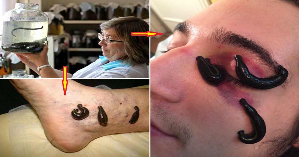 leech therapy leech therapy